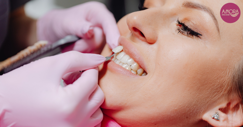 Blanqueamiento Dental