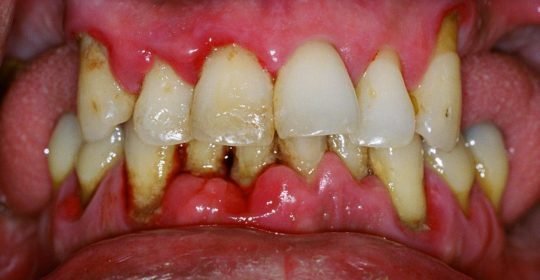 Diabetes y enfermedades periodontales encías inflamadas