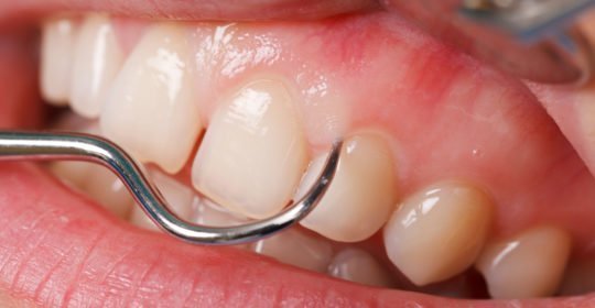 Diabetes y enfermedades periodontales limpieza bucal