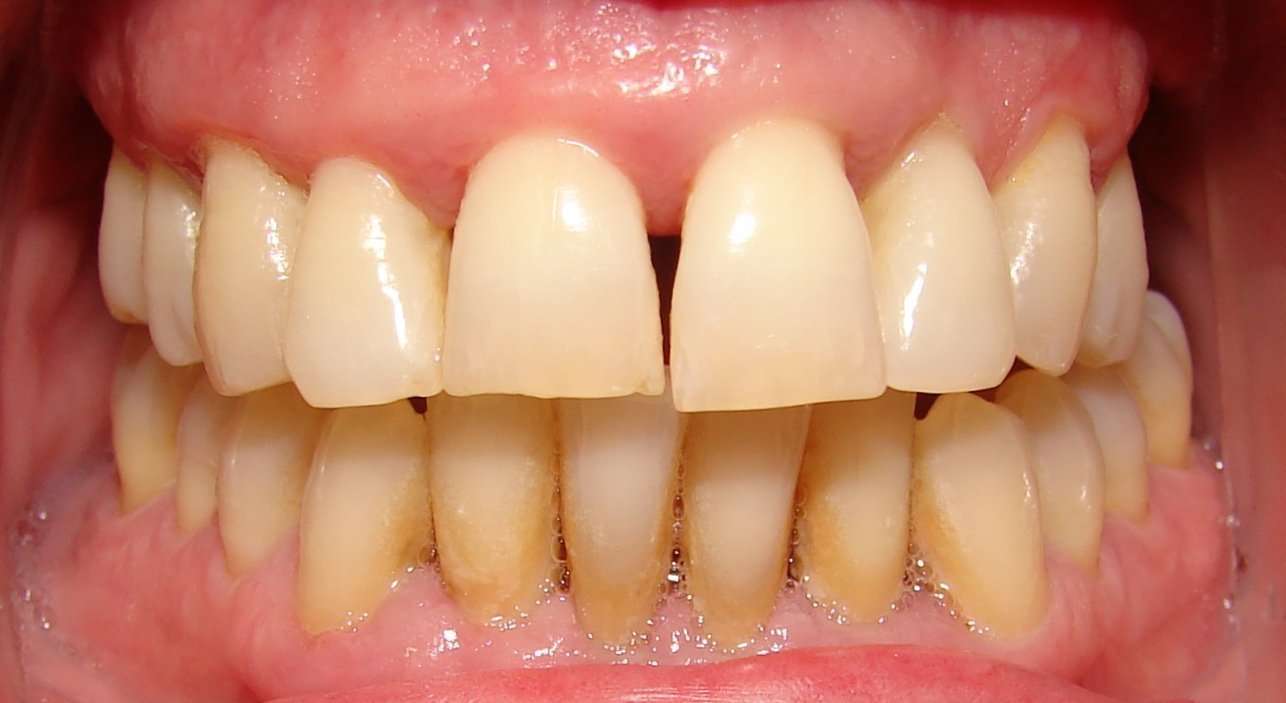 Diabetes y enfermedades periodontales portada