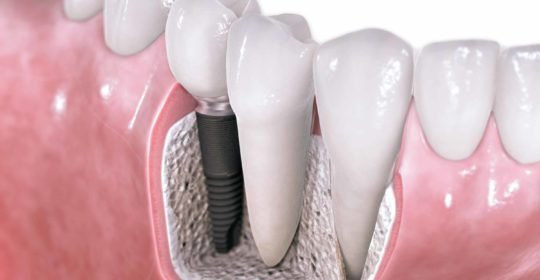 Implantes dentales Adín fiabilidad