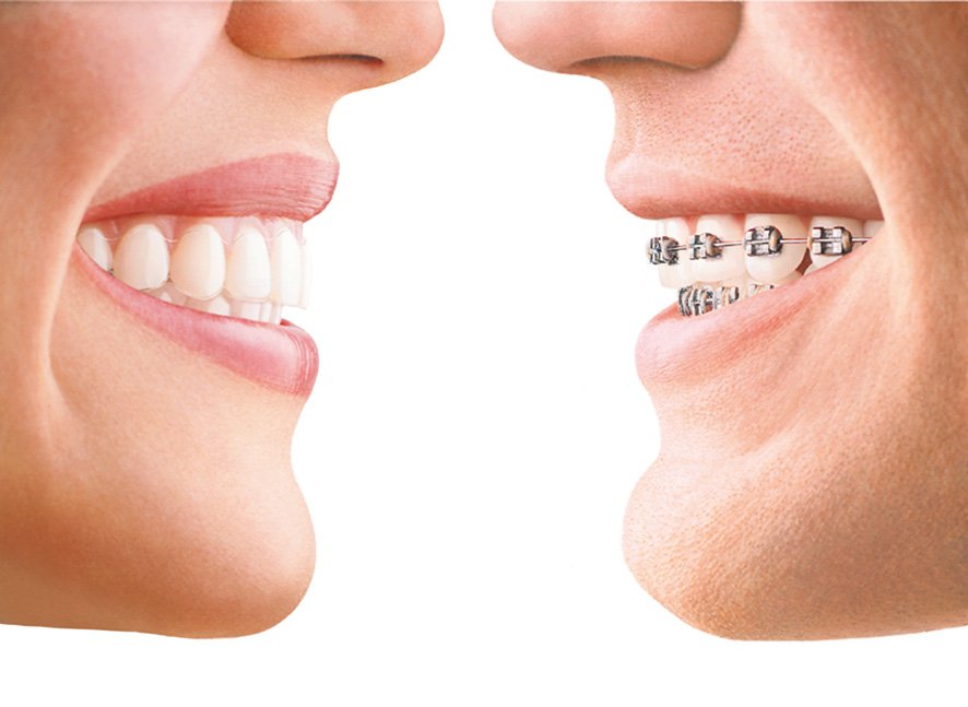 Invisalign