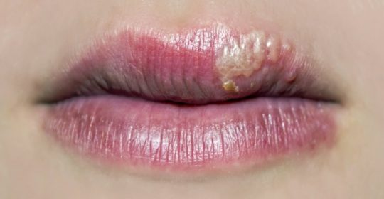 Morderse las uñas infecciones orales