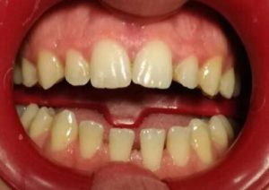 blanqueamiento dental antes
