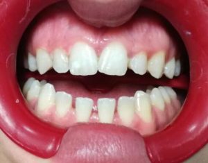 blanqueamiento dental después