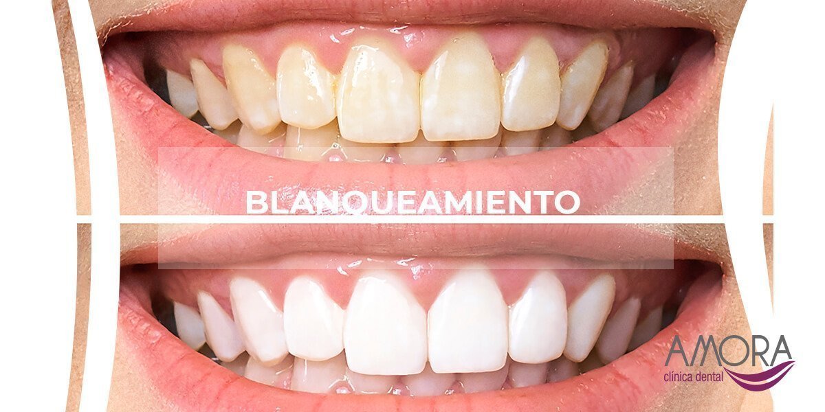 blanqueamiento dental Amora clínica dental