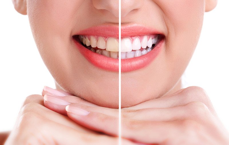 servicios dentales blanqueamiento dental Clínica Dental Sabadell