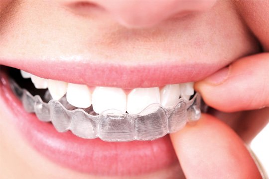 comer con invisalign