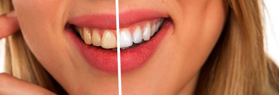 dentifricos blanqueantes
