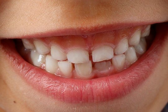 cuidar dientes de leche