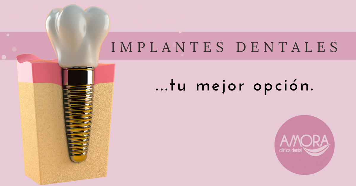 implantes dentales