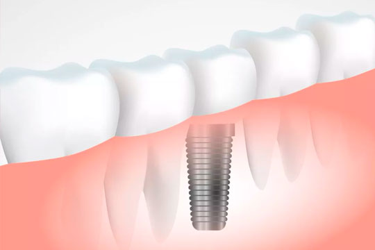 Implantes dentales