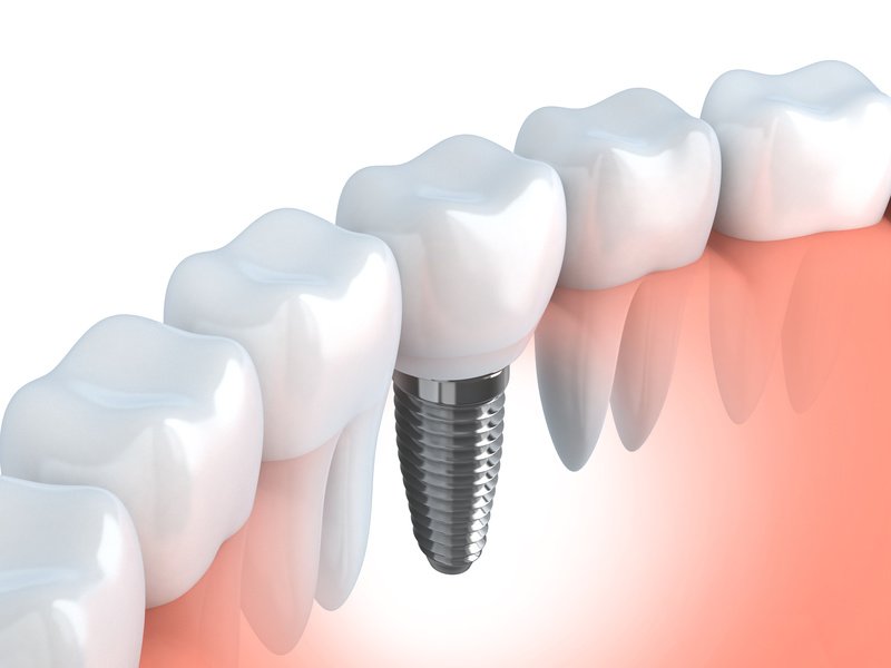 servicios dentales implantes Clínica Dental Sabadell