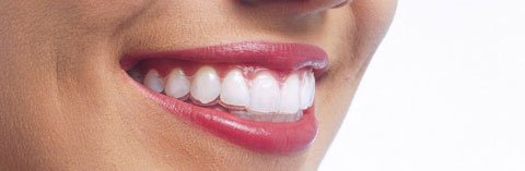 invisalign sonrisa 2