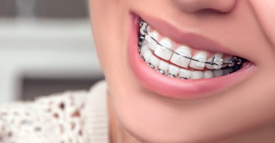 mis dientes se mueven ortodoncia